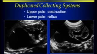 RenalAdrenalRetroperitoneal Ultrasound [upl. by Jarad250]