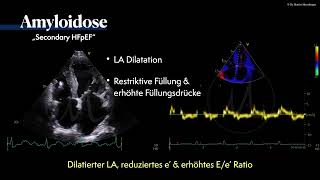 〖Echokardiografie〗 Amyloidose  HFpEF Phänotyp🫀 [upl. by Ariamat765]