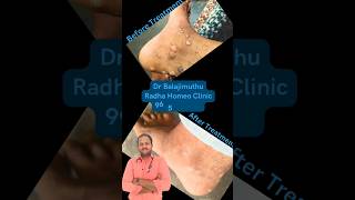 Wart Remover Ointment In Tamil  Wart Remover In Tamil  Wart Remover  Wart  Radha Homeo Clinic [upl. by Huan]