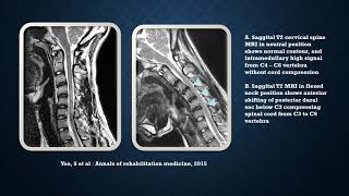 Neurology Quiz 24 TopicsMonomelic Amyotrophy Hirayama Disease Suprascapular nerve [upl. by Zanlog]