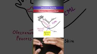 Olecranon Bursitis orthopedics inicet neetpg [upl. by Gustie]