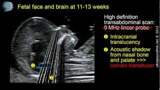 Fetal face and brain high definition scan at 1113 weeks [upl. by Reklaw782]