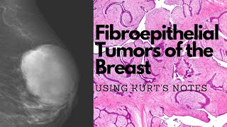 Fibroadenomas and Phyllodes Tumor of the Breast Using Kurt’s Notes pathagonia [upl. by Mashe736]