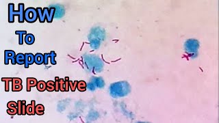 How To Report Positive Sputum Slide TB Positive Slide  ZN Stain  Mycobacterium Tuberculosis [upl. by Atikahs]