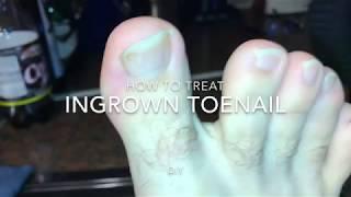 How to treat Ingrowing toenail with a scissor and an edge lifter DIY [upl. by Narton557]