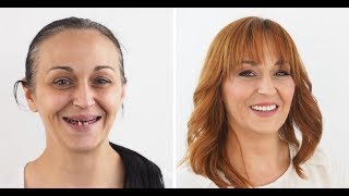 Dentalni makeover 2018 ŠTIMAC CENTRA DENTALNE MEDICINE  Mirela [upl. by Guthrey]