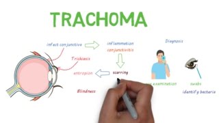 Trachoma  a devastating infectious eye disease [upl. by Belamy222]