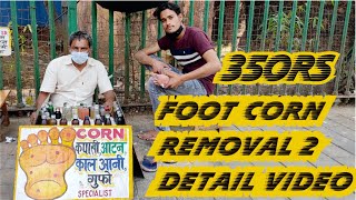 Foot corn removal complete detail videostep by step PART 2  Byculla Mumbai [upl. by Riddle470]