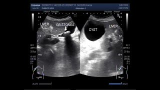 Ultrasound Video showing the Differentiation between Simple Hepatic Cyst and Hydatid Cyst [upl. by Hartzke]