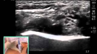 ULTRASOUNDGUIDED SUPRACLAVICULAR NERVE BLOCK [upl. by Drye]