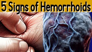 5 signs and symptoms of Hemorrhoids and treatment [upl. by Asimaj460]