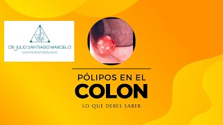 Pólipos de colon [upl. by Georgie]