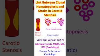 Link Between Clonal Hematopoiesis and Stroke in Carotid Stenosis [upl. by Jasmina]