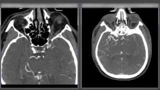 Large Artery Occlusion  ICA [upl. by Rennerb]