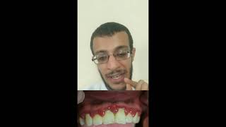 الفيديو الثالث في كورس Dental drugs Acute necrotizing ulcerative gingivitis [upl. by Gipps]