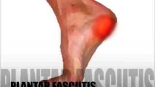 Plantar Fasciitis Diagnosis amp Treatment [upl. by Laleb]