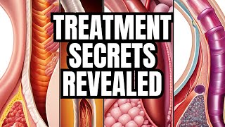 Barretts Esophagus Secrets to Treatment [upl. by Casar773]