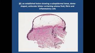 Lecture48 Bullous Pemphigoid and related diseases PartI Rooks chapter 50 [upl. by Gmur]