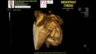 Anencephaly 17 weeks [upl. by Acireed]