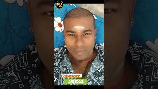 REVEALING MY HAIR TRANSPLANT JOURNEY 💥🔥 F2HairTransplantandSkinCare clinic Velachery Chennai [upl. by Ramad]