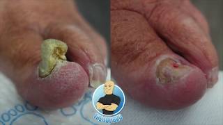 TRIMMING A quotTHICCquot TOENAIL  AMAZING BEFORE AND AFTER [upl. by Therron]