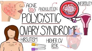 Polycystic Ovary Syndrome Made Easy PCOS Explained [upl. by Nuahc514]