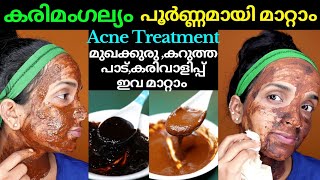 KarimangalyamampAcne treatment at home❤Best natural skin brightening face pack❤Remove blackwhiteheads [upl. by Zorine]