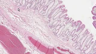 Tubular Adenoma amp Adenomatous Polyp Histopathology  Madeformedicalcom [upl. by Akiemahs808]