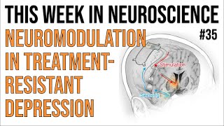 TWiN 35 Neuromodulation in treatmentresistant depression [upl. by Reedy494]