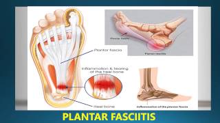 Best Insoles For Plantar Fasciitis Reviews [upl. by Idahs]