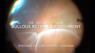 Bullous Retinal Detachment management  Dr Jivitesh Singh [upl. by Lihas]