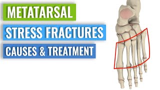 Metatarsal Stress Fractures  Causes Treatment Prevention [upl. by Nonnairb]