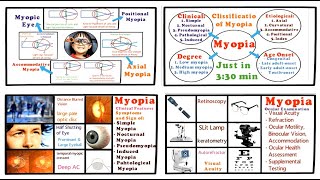 Myopia  Full Tutorial Introduction Classification Clinical Features and Management [upl. by Amikahs]