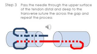 Flexor tendon repair  modified Kesser [upl. by Eelynnhoj631]