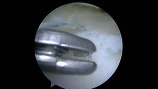 Difficult Anterior Horn Meniscus tear Repaired with Novostitch Plus [upl. by Frankel405]