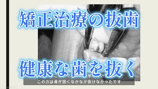 ⚠抜歯動画【矯正のための抜歯】 [upl. by Netsrik]