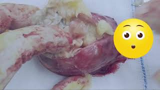 Gynecology 101 DERMOID CYST [upl. by Ecirtam]