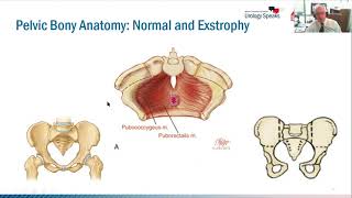 1000 Exstrophies Lesson Learned for Families and Physicians [upl. by Yevrah]