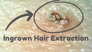 Ingrown Hair Extraction Unraveling the Wildest Twirliest Hairs ASMR Marathon [upl. by Artima]