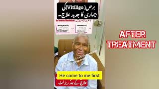 Vitiligo skin disease treatment in pakistan in urdu  Part 3  burs ka ilaj [upl. by Faucher761]