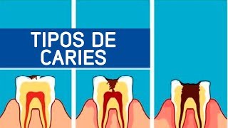 Tipos de caries  Odontoespecialistas [upl. by Trela]