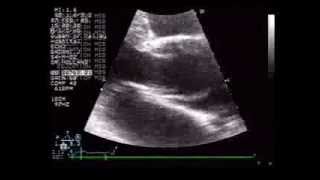 Diagnosis of aortic dissection by TTE [upl. by Alocin]