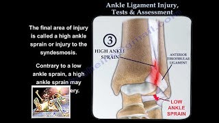 Ankle Ligament Injury evaluation and tests  Everything You Need To Know  Dr Nabil Ebraheim [upl. by Malony]