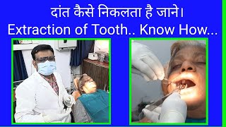 दांत कैसे निकलता है जाने।। Extraction of Tooth Know How [upl. by Ardnasirk]