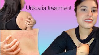 How I cured my chronic urticaria hives treatment hives urticaria ayurvedic sheetpit [upl. by Sarine404]