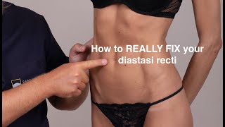 How To Really Fix Your Diastasi Recti  Dr Darecchio [upl. by Ahsiuqram352]