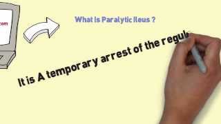 What Is Paralytic Ileus and Ways Of Ileus Treatment [upl. by Akemyt513]