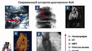 Коарктация аорты симптомы диагностика лечение [upl. by Sauncho]