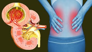 Nephritis Causes And Treatment [upl. by Ettezzil]