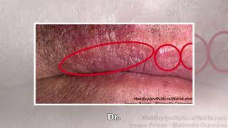 Fordyce Spots – Causes Symptoms and Treatments [upl. by Ygief]